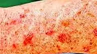 نکات کلیدی برای پیشگیری از سرطان پوست