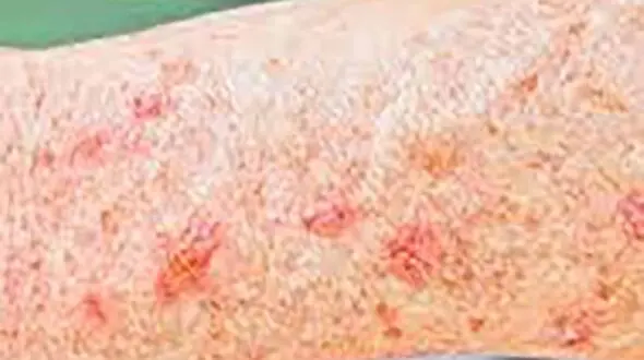 نکات کلیدی برای پیشگیری از سرطان پوست