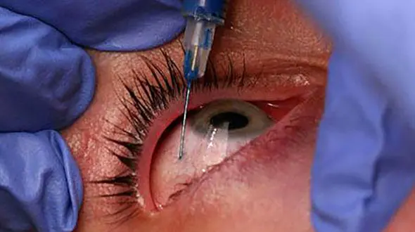 52 جفت چشم در کرج و تهران چگونه کور شدند !  / مقصران مجازات می شوند!