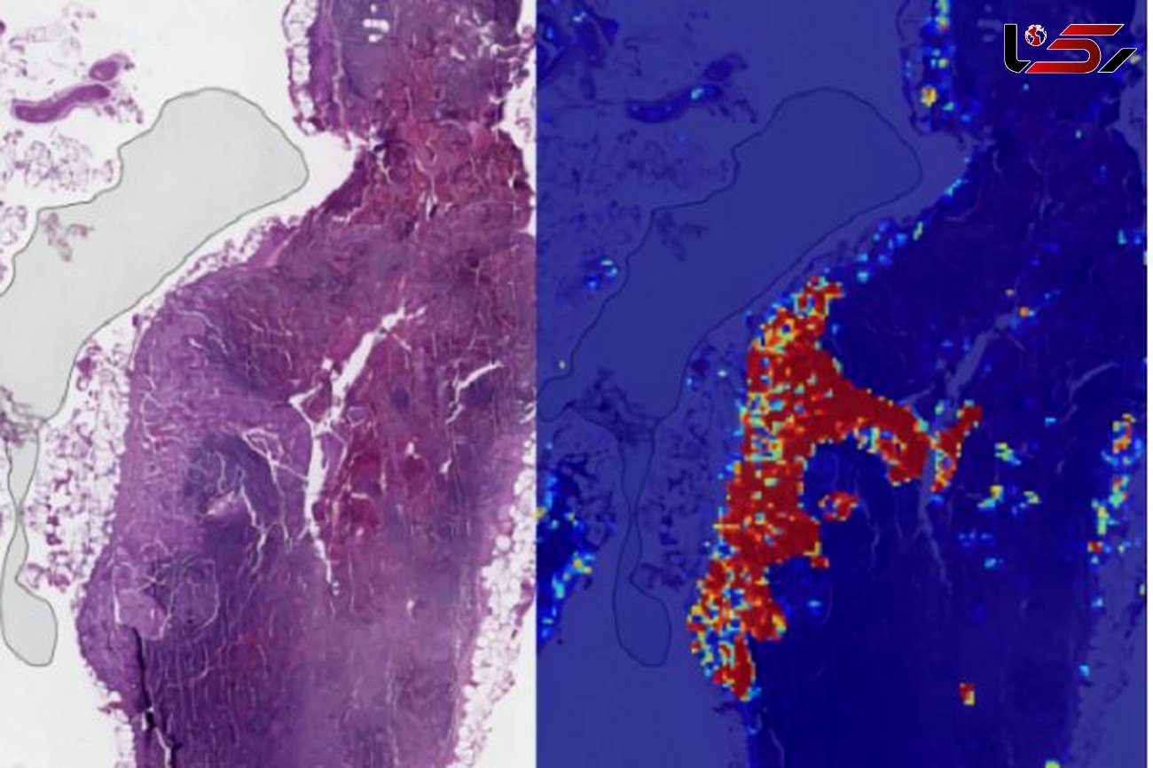 سرطان سینه با هوش مصنوعی قابل تشخیص است