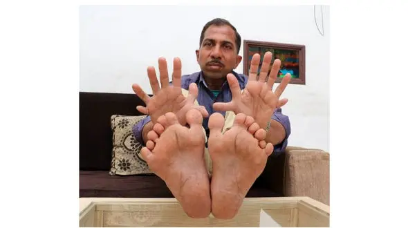 مرد عجیب الخلقه در هند زندگی می کند!+عکس