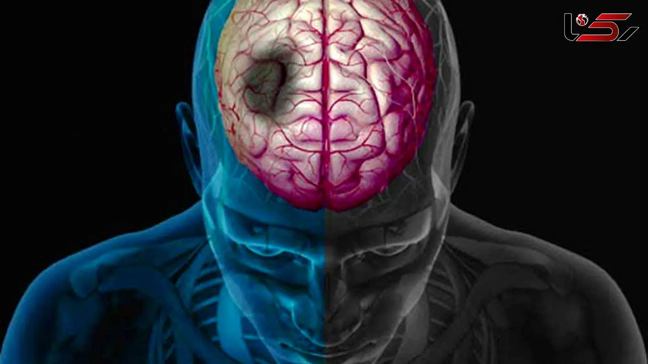 رابطه تزریق واکسن آنفلوانزا و کاهش خطر سکته مغزی