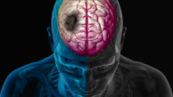 چرا فرد دچار سکته مغزی می شود؟ + اینفوگرافی