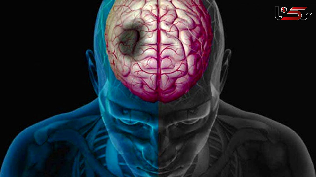 چرا فرد دچار سکته مغزی می شود؟ + اینفوگرافی