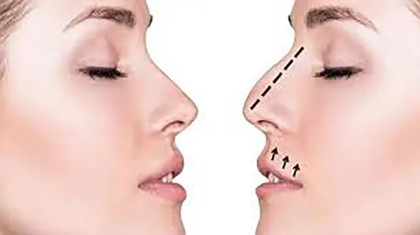 بینی لیرزی،یک دروغ بزرگ!