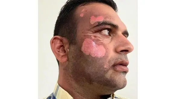 شکارچی غیرمجاز، محیط بان مازندرانی را سوزاند!