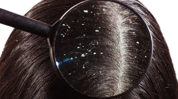 ارتباط شوره سر با بیماری روده