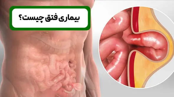 فتق چیست؟ / جدول انواع فتق، علائم و روش‌ های درمان