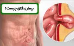 فتق چیست؟ / جدول انواع فتق، علائم و روش‌ های درمان