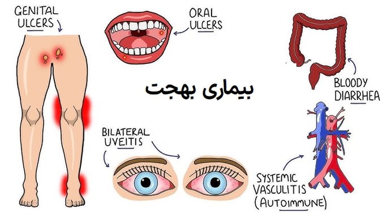 بیماری بهجت