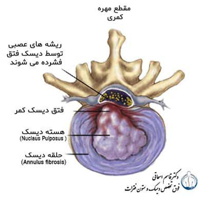 پارگی دیسک کمر