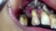 زشت ترین صحنه ای که یک دندانپزشک با آن روبرو شد + فیلم (14+)