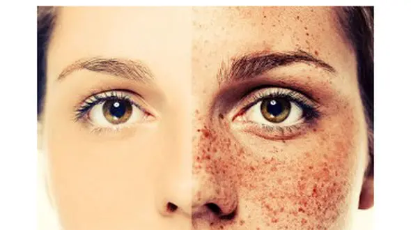 راه های درمان کک و مک صورت +عکس 