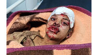 3 عکس از چهره های آسیب دیده نوجوان ایلامی که دلها را تکان می دهد/ انفجار مین حادثه آفرید
