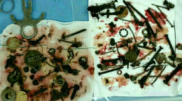  150 قطعه فلزی در شکم یک بیمار مشهدی جا خوش کرده بودند+عکس