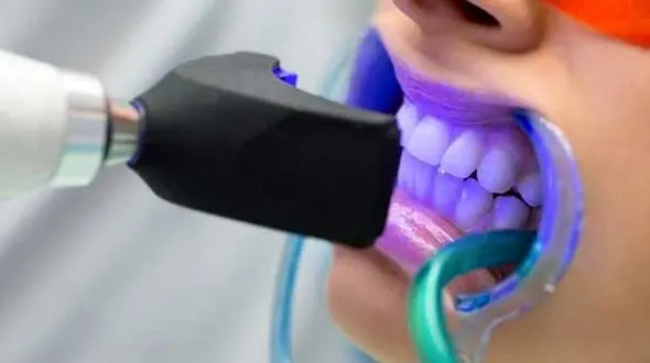 نکاتی مهم قبل از سفید کردن دندان‌ ها