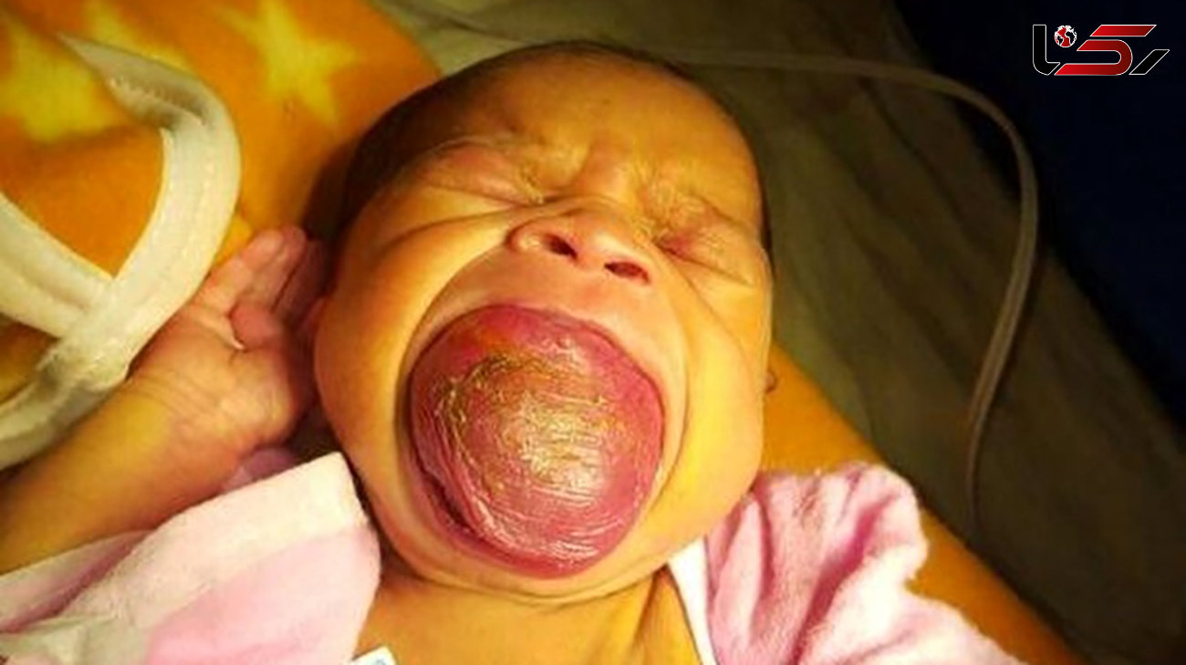 این نوزاد دختر زبان غول‌پیکری دارد !+ تصاویر 