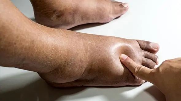 نوروپاتی یا زخم پای دیابتی چرا ایجاد می شود؟ + فیلم