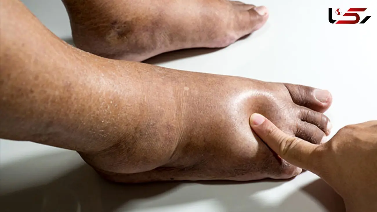 نوروپاتی یا زخم پای دیابتی چرا ایجاد می شود؟ + فیلم