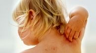 روش های درمان خارش پوست سر کودکان