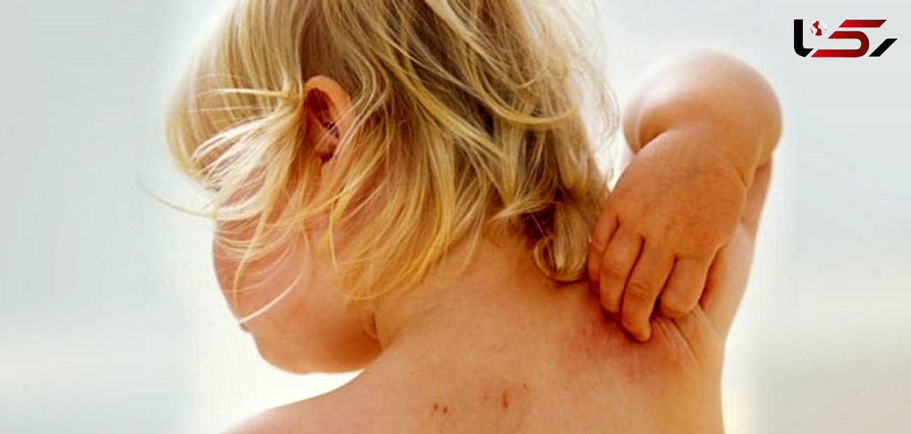 روش های درمان خارش پوست سر کودکان