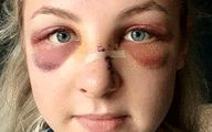 Boy, 16, who left officer's nose 'hanging off' in savage attack avoids prison