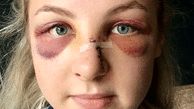 Boy, 16, who left officer's nose 'hanging off' in savage attack avoids prison