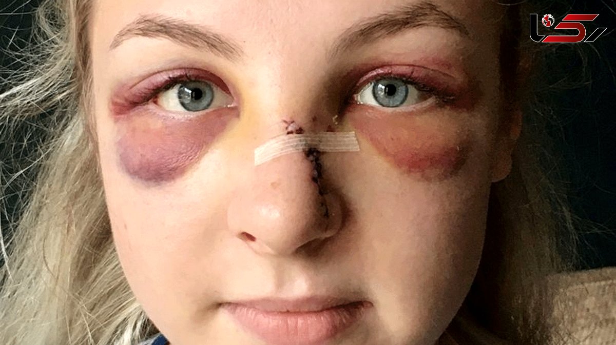 Boy, 16, who left officer's nose 'hanging off' in savage attack avoids prison