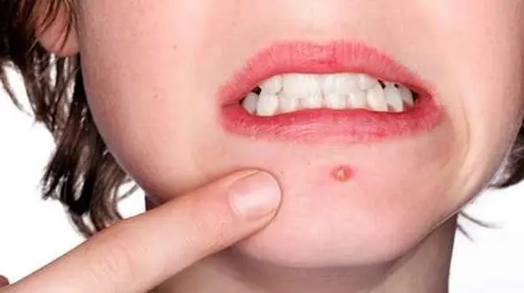 با دستکاری این جوش ها ناگهان زشت می شوید!