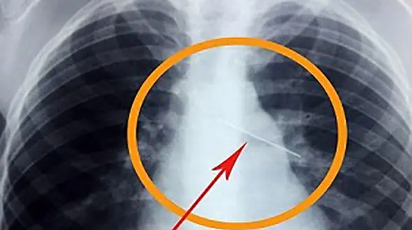  سوزن 4 سانتی در کبد نوزاد 11 ماهه جاخوش کرده بود