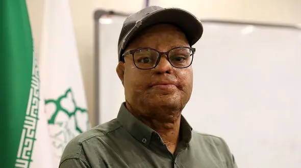 دردهای ناگفته قربانیان اسیدپاشی / نه تنها قصاص نمی شوند تهدیدمان هم می کنند + فیلم و جزییات