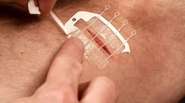 چطور جای زخم‌ها را  از بین ببریم ؟