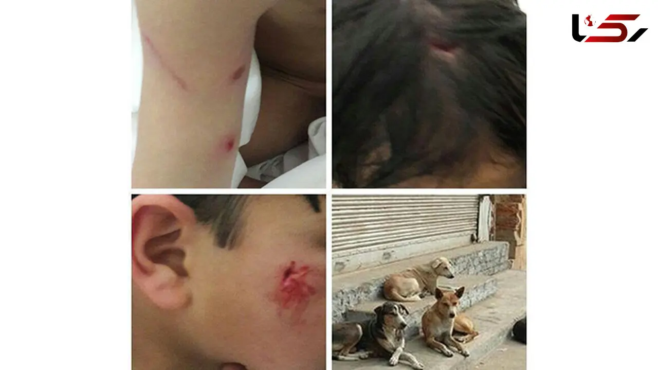 کودک ۷ ساله تفتی در میان چنگال های سگ ولگرد+ عکس
