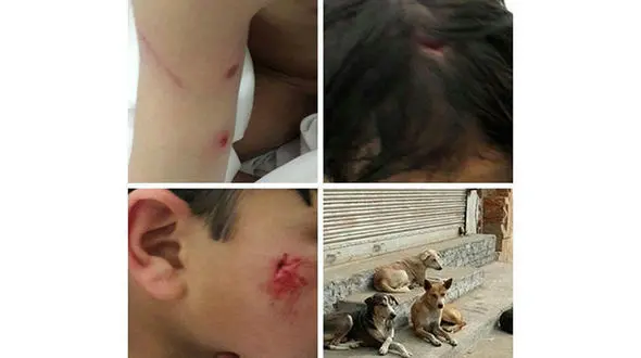 کودک ۷ ساله تفتی در میان چنگال های سگ ولگرد+ عکس
