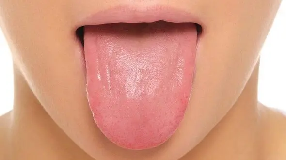 برفک دهان چه بیماری است؟