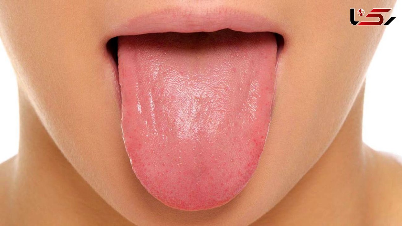 برفک دهان چه بیماری است؟