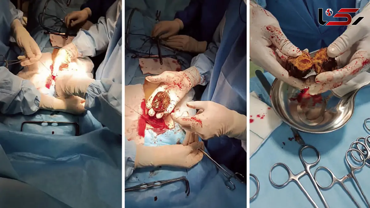 توده های مرموز خرمالو در معده بیماران مشهد