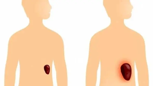 نشانه های بزرگ شدن طحال 