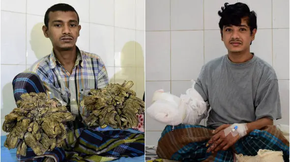 شاخ و برگ «مرد درختی» قطع شد+فیلم و عکس