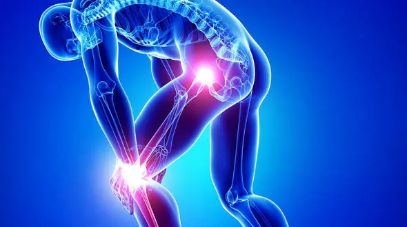 اضافه وزن، انحراف زانو و عفونت، از عوامل اصلی بروز آرتروز زانو