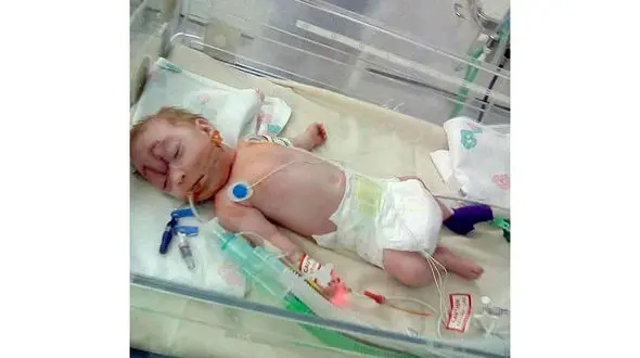 چهره عجیب نوزاد هنگام تولد پزشکان را حیرت زده کرد