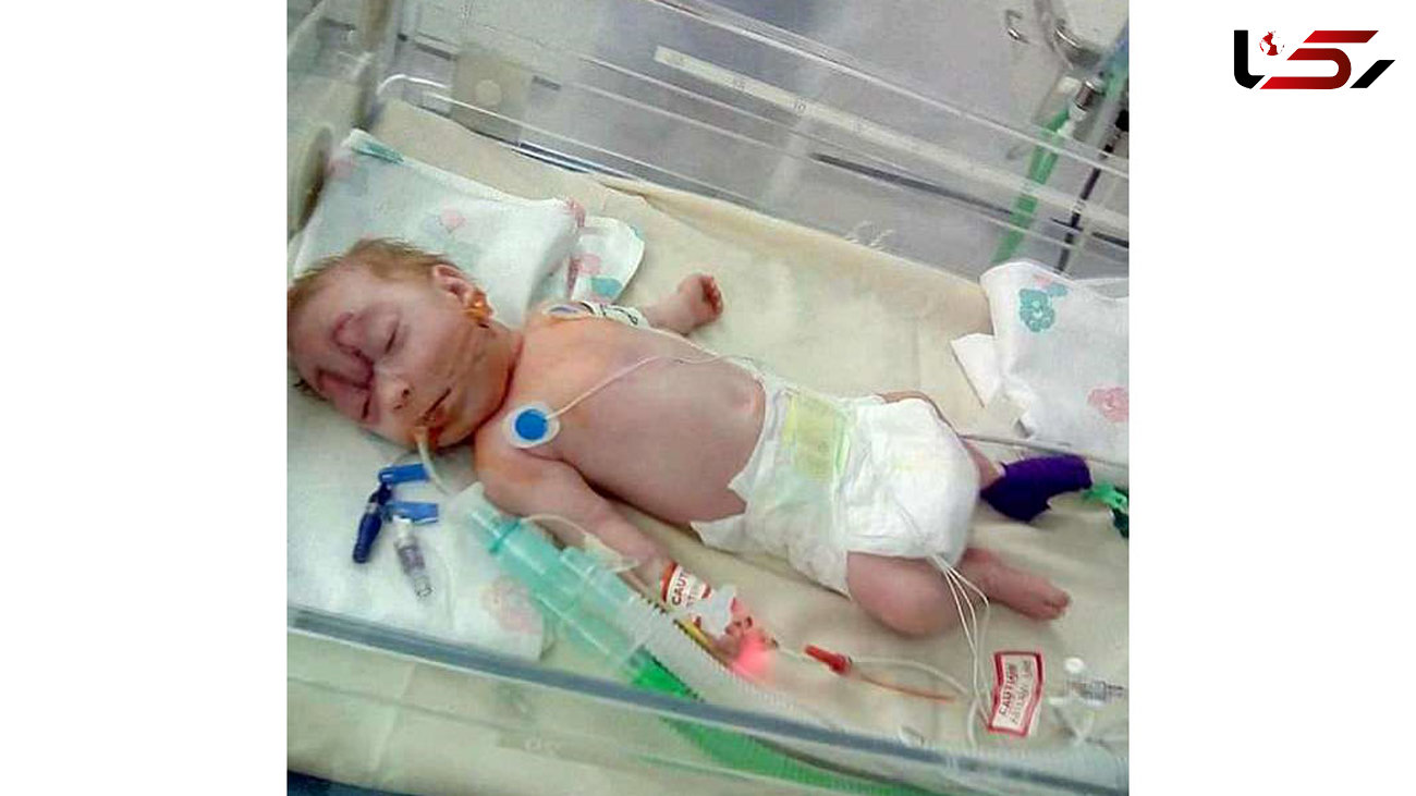 چهره عجیب نوزاد هنگام تولد پزشکان را حیرت زده کرد