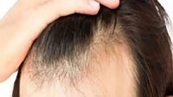 آیا رنگ کردن مو باعث ریزش مو می شود؟