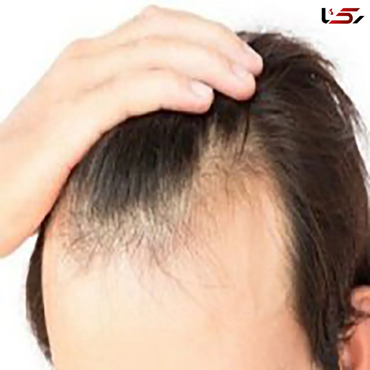 نقش ویتامین ها در ریزش مو