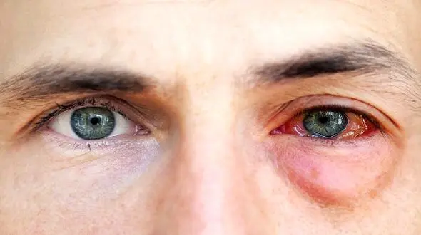 تأثیر کرونا بر چشم‌ها؛ چگونه از سلامت چشمان خود محافظت کنیم