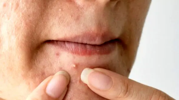 پیشگیری از جوش / عوارض دستکاری جوش + علل ایجاد جوش