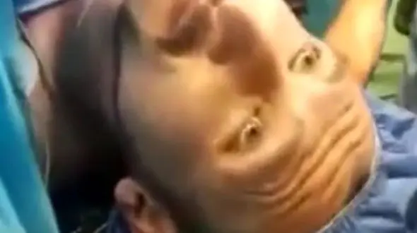 اولین عمل جراحی ارتوپدی با هیپنوتیزم در ایران +فیلم و عکس