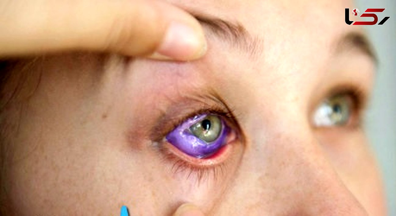 خالکوبی در سفیدی چشم منجر به نابینایی دختر جوان شد