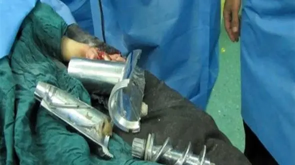 بی احتیاطی والدین چهار انگشت دست کودک 3 ساله را گرفت