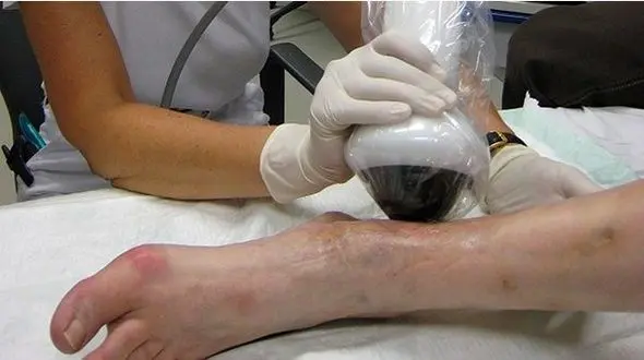 بهبود زخم دیابت با دستگاه شوک موجی